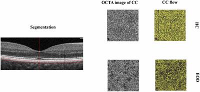 Choriocapillaris Changes Are Correlated With Disease Duration and MoCA Score in Early-Onset Dementia